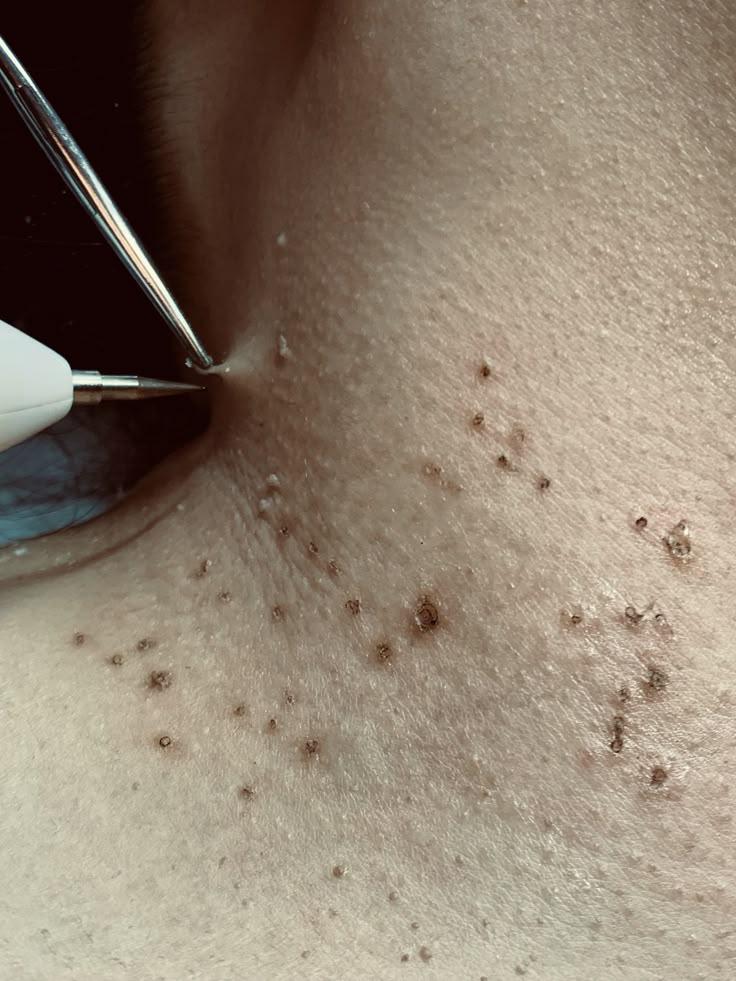 Remove Skin Tags