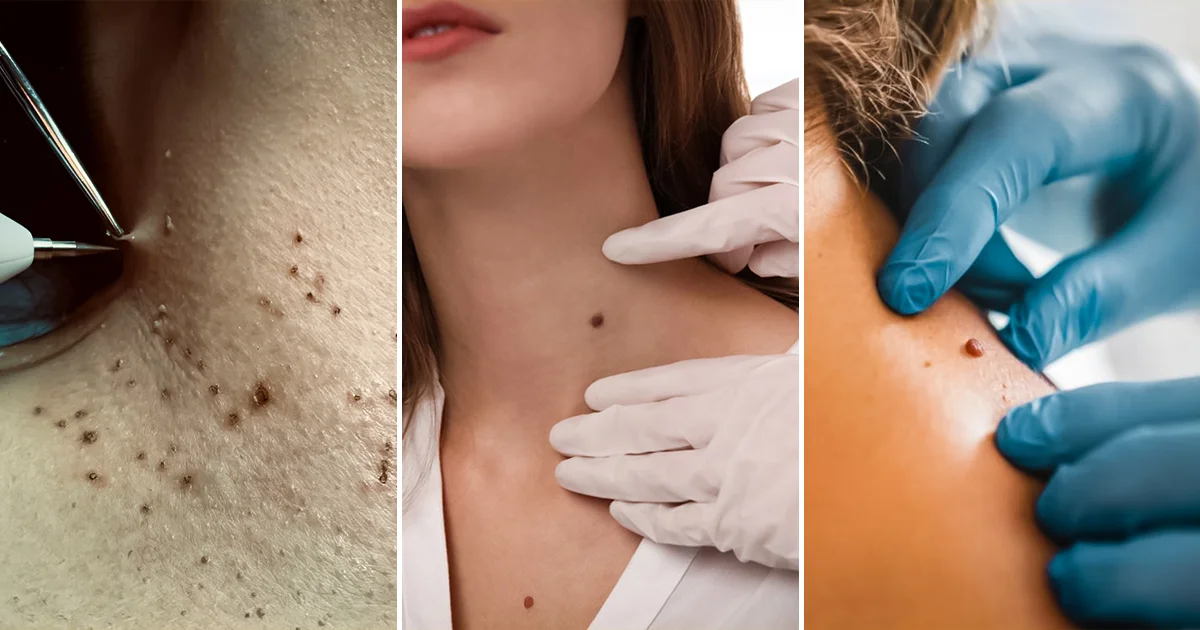 Remove Skin Tags