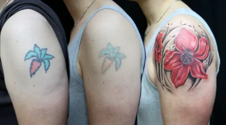 Tattoo Removal Methods Explained for Better Skin Choices