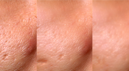 How Microneedling for Acne Scars Actually Works Beneath the Skin