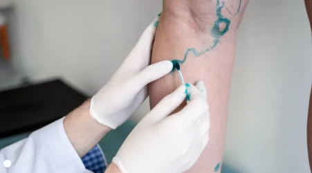 Varicose Veins Treatment Brisbane: A Practical Guide