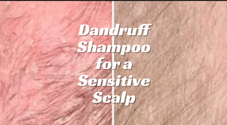 Choosing a Dandruff Shampoo for a Sensitive Scalp